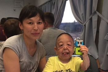 Фотография к новости: Мальчику с синдромом вялой кожи провели операцию в Алматы