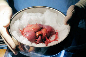 Фотография к новости: Продавших почку супругов осудили в Астане 