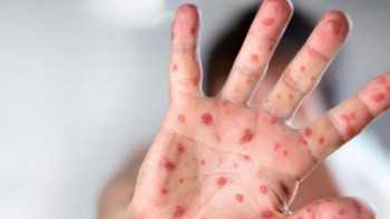 Фотография к новости: 41 ребёнок заболел корью в Атырауской области