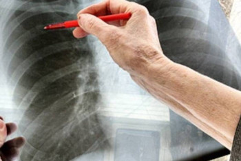 Фотография к новости: Заболеваемость туберкулезом в Казахстане снизилась в 2,4 раза за последние 10 лет