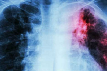 Фотография к новости: У воспитателя детского сада обнаружили туберкулез в ВКО