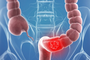 Фотография к новости: Казахстанцев приглашают бесплатно обследоваться на рак толстого кишечника