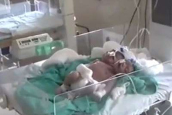 Фотография к новости: В Индии родился двухголовый младенец с тремя руками