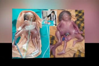 Фотография к новости: В Индии родилась девочка с 8 конечностями