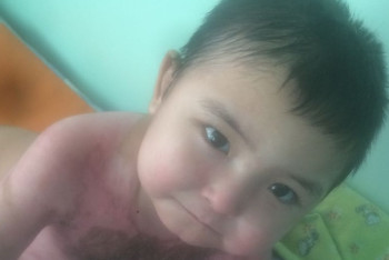 Фотография к новости: В Кокшетау трехлетний мальчик с 80% ожогами тела готовится к выписке