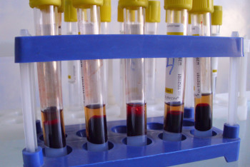 Фотография к новости: ВИЧ у 78-летнего дедушки выявили медики в Кызылорде 