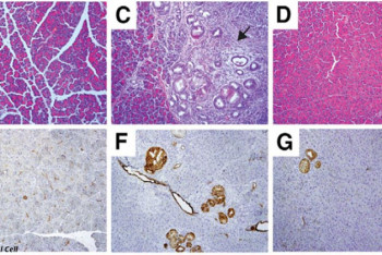 Фотография к новости: Учёные смогли "разубедить" превращаться в рак клетки поджелудочной железы
