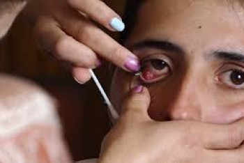 Фотография к новости: Врач объяснила причину появления слез-кристаллов у девушки из Армении