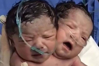 Фотография к новости: Девочка с двумя головами родилась в украинских Черновцах 