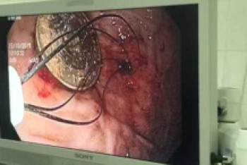 Фотография к новости: Ребенок проглотил 100 тенге в Алматы