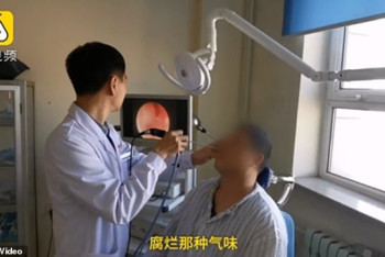 Фотография к новости: С зубом в носу прожил более 20 лет житель Китая