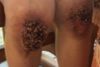 Фотография к новости: Садистские методы воспитания: Гречка вросла в колени мальчика из Омска