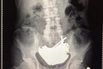 Фотография к новости: Почти килограмм шурупов извлекли врачи из желудка заключенного в Кокшетау