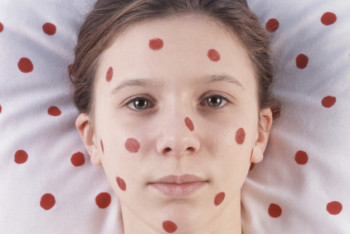 Фотография к новости: Сократилось почти в два раза число заболевших корью в Казахстане