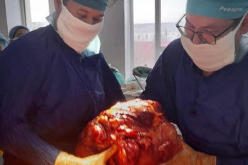 Фотография к новости: Раковую опухоль весом 15 килограммов удалили у жителя Атырау