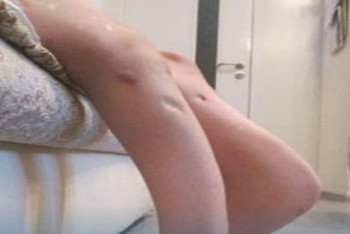 Фотография к новости: Пациентку с врождённой деформацией ног успешно прооперировали в Астане