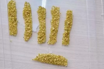 Фотография к новости: Более 1700 камней достали из желчного пузыря женщины в Алматы