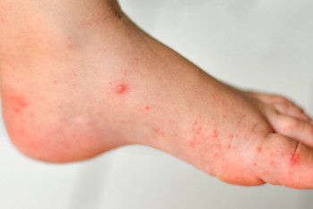 Фотография к новости: Вспышка? В Астане резко выросло количество заразившихся энтеровирусом