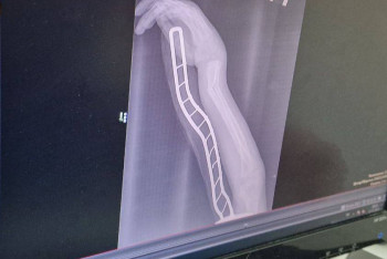 Фотография к новости: Тысяча снимков в сутки: единственный в Астане детский травмпункт не справляется с нагрузкой