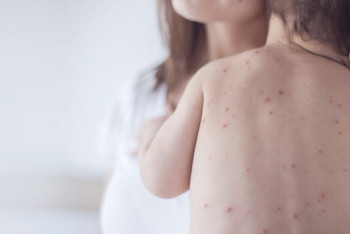 Фотография к новости: 73 случая заражения корью зарегистрировано в Карагандинской области за месяц