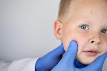 Фотография к новости: Эпидситуация по кори ухудшается в Карагандинской области