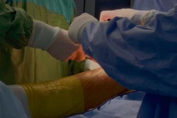 Фотография к новости: Алматинские врачи имплантировали искусственное бедро пациенту