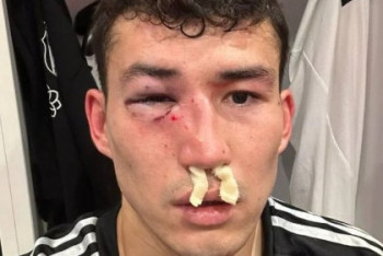 Фотография к новости: Зайнутдинову сломали нос перед решающими матчами сборной Казахстана в отборе Евро-2024