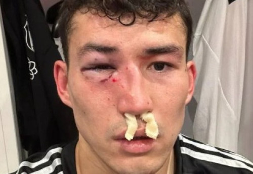 Фотография к новости: Зайнутдинову сломали нос перед решающими матчами сборной Казахстана в отборе Евро-2024