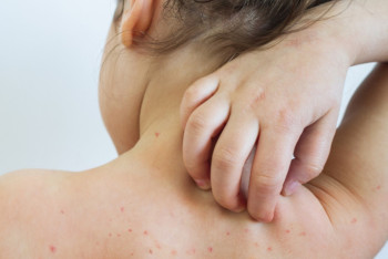 Фотография к новости: Вспышка кори в Кыргызстане: заболели больше четырёх тысяч человек