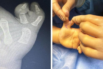 Фотография к новости: Шестой палец на руке удалили двухлетней алматинке