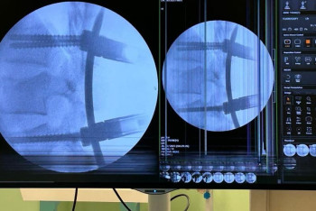 Фотография к новости: Подростка с травмой позвоночника спасли от инвалидности врачи Алматы
