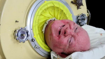 Фотография к новости: В США скончался один из последних пациентов "железных легких"