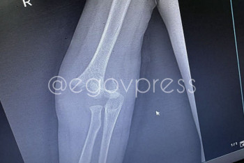 Фотография к новости: В Алматы девочка с аутизмом сломала руку в коррекционном центре