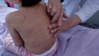 Фотография к новости: Более 50 детей госпитализированы с корью в Астане