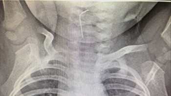 Фотография к новости: В Туркестане спасли ребёнка, проглотившего иглу