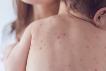 Фотография к новости: Причину роста заболеваемости корью объяснили в Минздраве РК