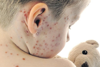 Фотография к новости: 93 человека заболели корью в Казахстане с начала года