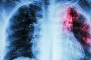 Фотография к новости: Четыре млн больных туберкулёзом не лечатся - ВОЗ