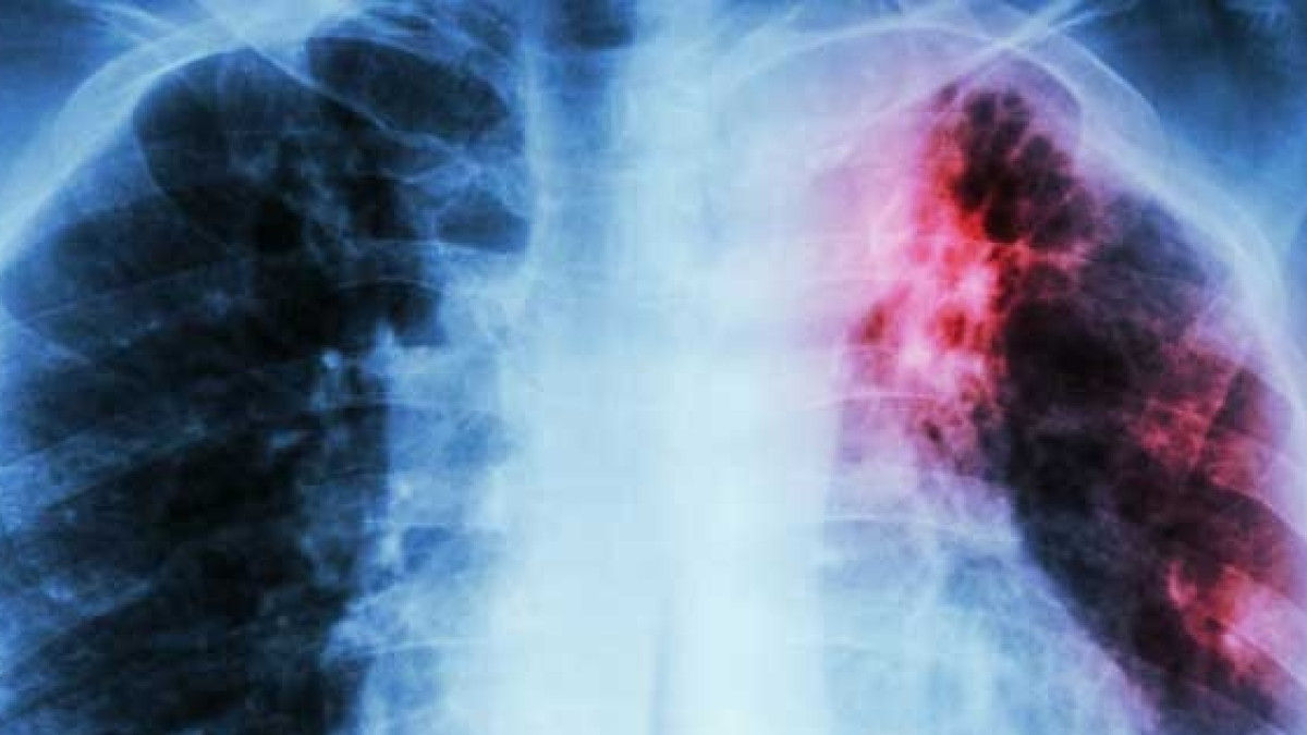 У воспитателя детского сада обнаружили туберкулез в ВКО