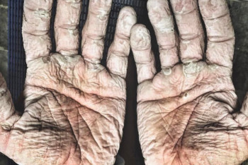 Чемпион показал шокирующее фото ладоней после заплыва в Ледовитом океане