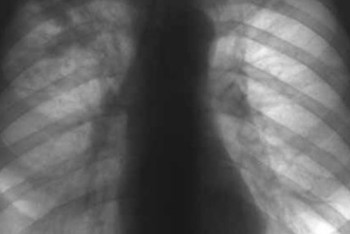 В Туркестане расследуют массовое заражение туберкулезом в психоневрологическом учреждении