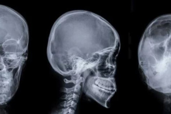 Фотография к новости: Робот проникает в мозг человека и лечит инсульт