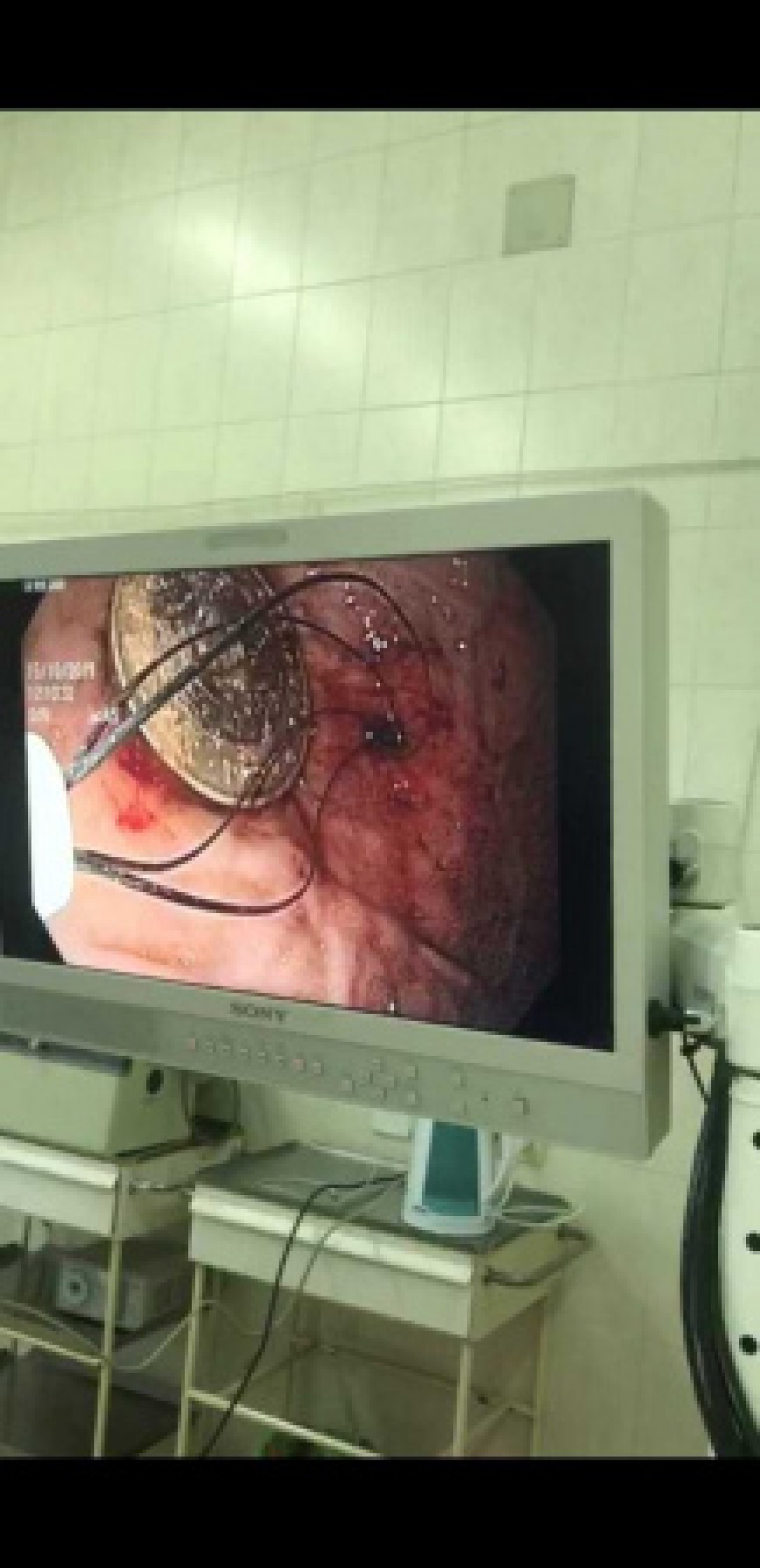 Ребенок проглотил 100 тенге в Алматы