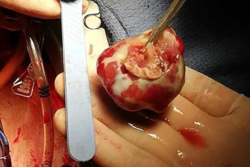 Фотография к новости: Врачи спасли жизнь жительнице Алматы, удалив опухоль из сердца