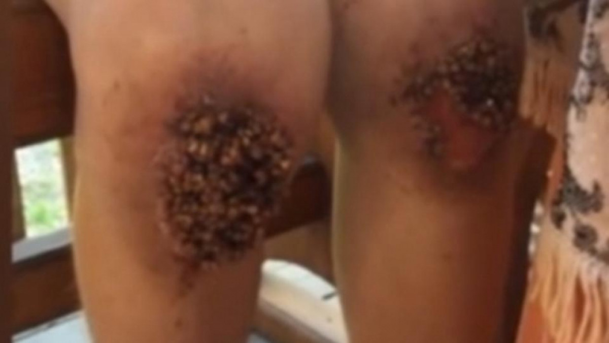 Садистские методы воспитания: Гречка вросла в колени мальчика из Омска