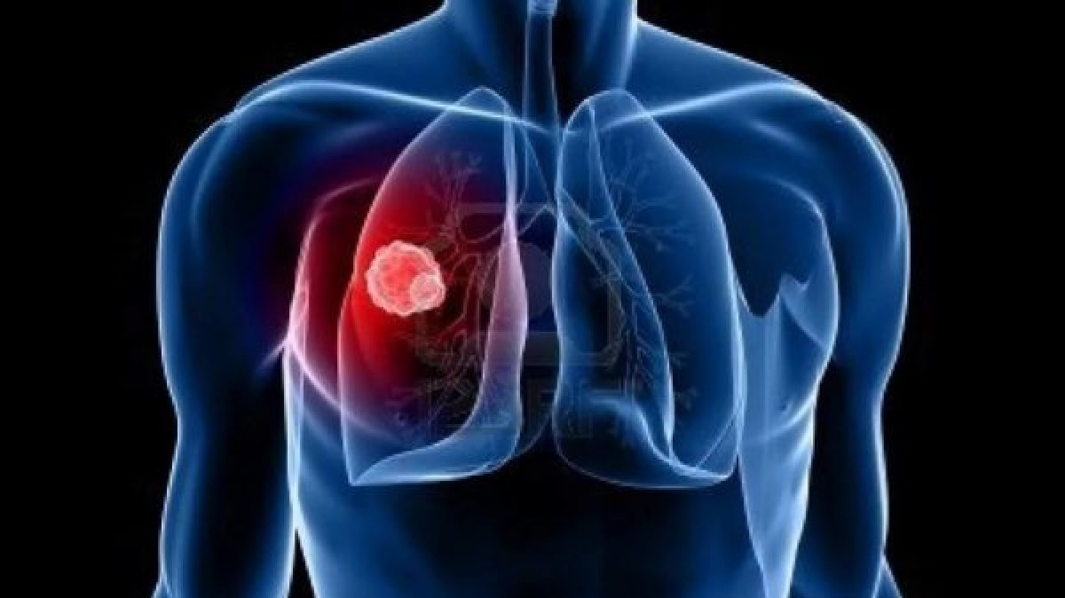 В 15 раз снизилась смертность от туберкулёза в Акмолинской области