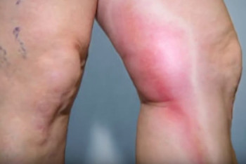 Оказалось, рожа. Санврачи прокомментировали "новогоднее заражение" жителя Кокшетау сибирской язвой