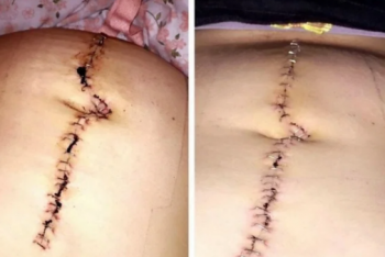 Фотография к новости: Британка приняла 6-килограммовую раковую опухоль за беременность