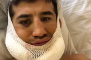 Фотография к новости: Боец ММА перенес операцию после двойного перелома челюсти в бою с Арманом Оспановым