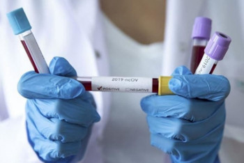 Фотография к новости: Еще 77 случаев заражения КВИ зафиксировано в Казахстане